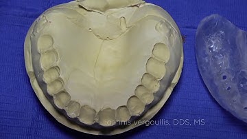 Full Arch Immediate Loading