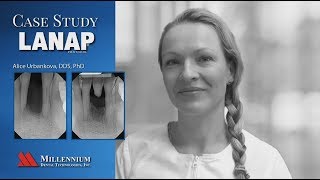 CASE STUDY  LANAP Treatment Saves Completely Loose Tooth