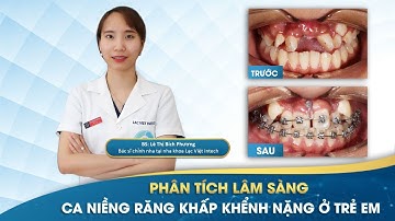PHÂN TÍCH LÂM SÀNG CA NIỀNG RĂNG KHẤP KHỂNH NẶNG Ở TRẺ