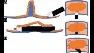 Single tunneling technique for the resection of lateral spreading adenomas