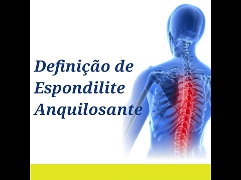 ESPONDILITE ANQUILOSANTE Doença Inflamatória Crônica da Coluna Clínica Fisioterapia Dr. Robson Sitta