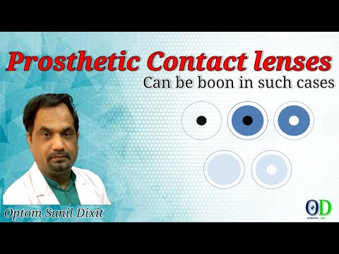 Prosthetic contact lenses || Can be boon in such Cases