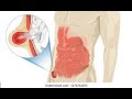 "INDIRECT INGUINAL HERNIA"#learning #inguinalhernia