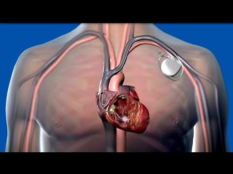 ჯანმრთელობის ეროვნული სააგენტო კარდიოვერტერ-დეფიბრილატორებს  პაციენტებს უსასყიდლოდ  გადასცემს