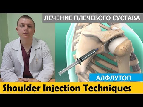Локальная инъекция | Лечение боли в плече | АЛФЛУТОП | Subacromial Shoulder Injections