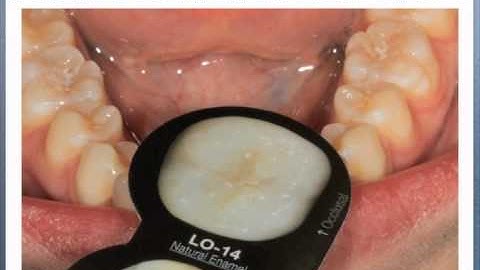 Custom Posterior Shade Videos