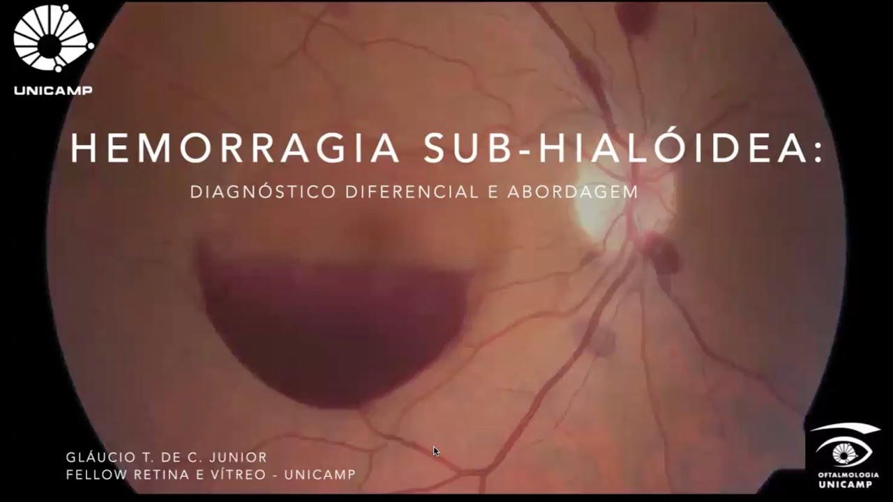 Retina e Vítreo (23/10/2025) - Hemorragia Sub-hialoidea: diagnóstico diferencial e abordagem
