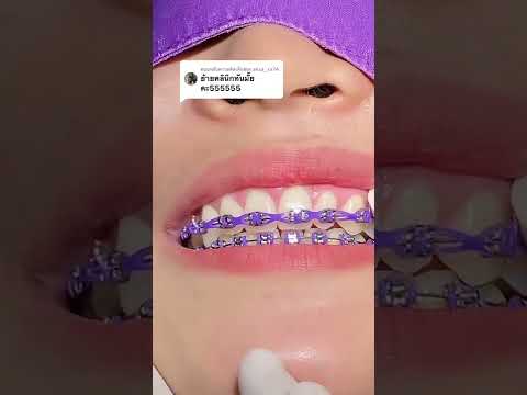 วีดีโอ: วิธีต่อยางรัดเข้ากับเหล็กจัดฟัน: 12 ขั้นตอน