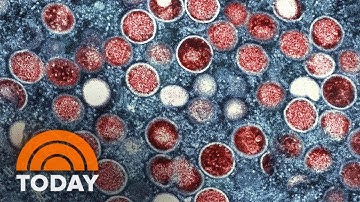 New York Declares State Of Emergency Over Spread Of Monkeypox