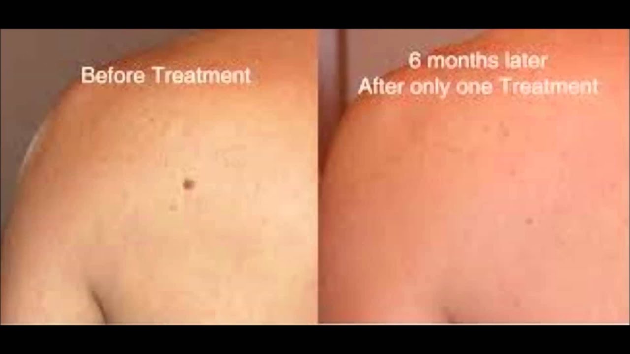 dermatologist spring tx sonic skin care mole removal spring tx YouTube