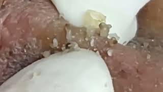 Прыщи / Огромные прыщи / Релакс с акне / Выдавливание прыщей / Черная точка #Прыщи