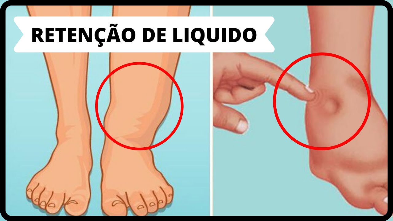 💢CHÁS PARA RETENÇÃO DE LIQUIDO E INCHAÇO NO CORPO!! - YouTube