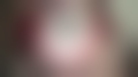 ARTIFICIALIRIS: sulcus implantation - with suture fixation