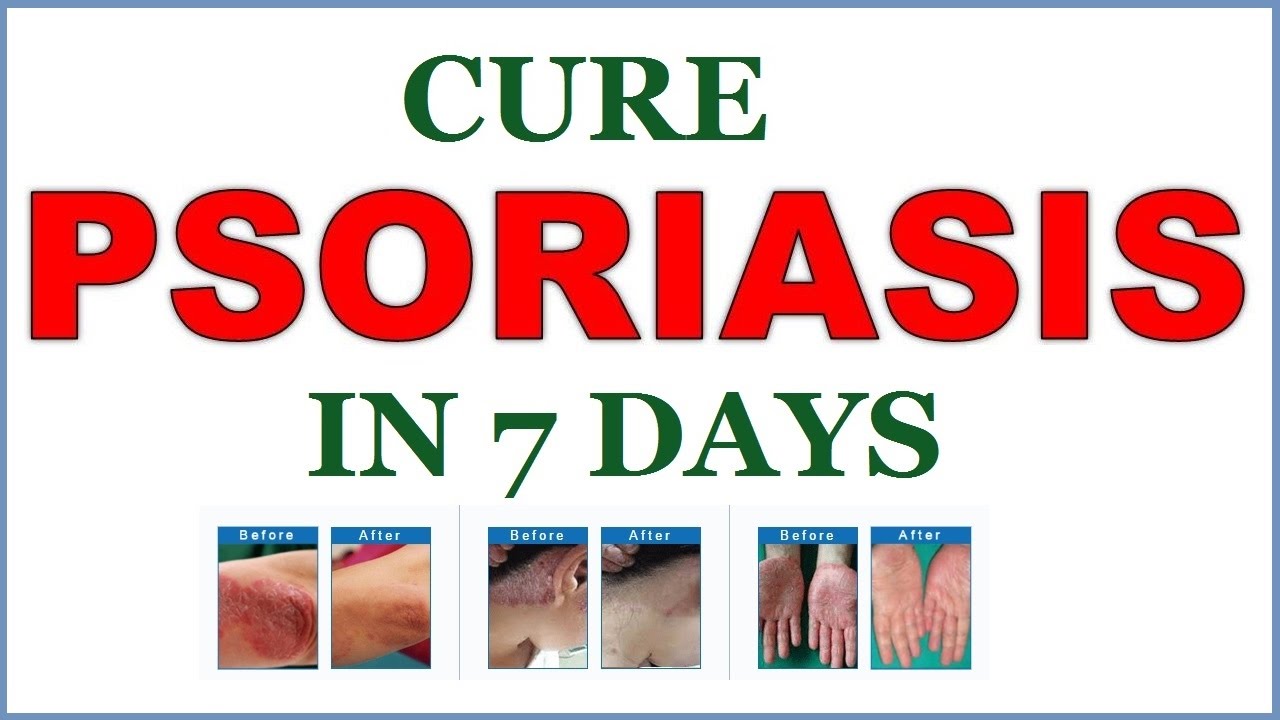 Psoriasis Medication Pill Form Natural Herbal Medicine