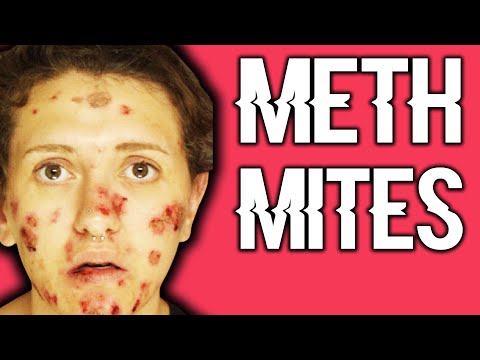 What Are Meth Mites & Why Do They Occur?