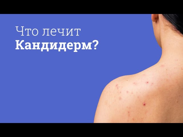 Кандидерм: инструкция по применению