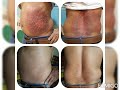 Results on psoriasis  eczema with vitamin d therapy dr renu mahtani md