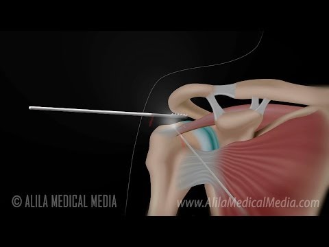 Arthroscopic Rotator Cuff Repair Surgery Animation.