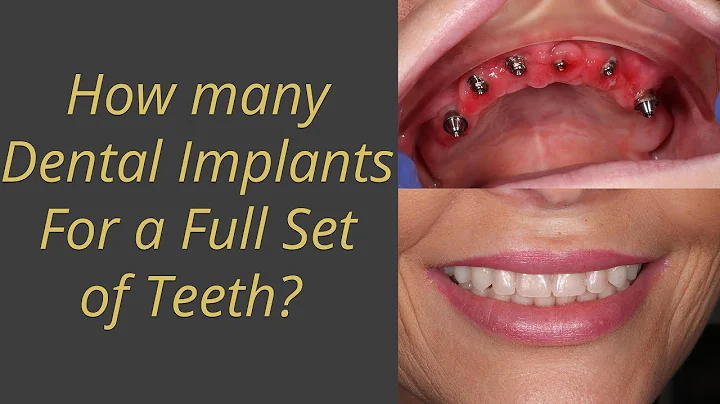 ஒரு முழுமையான பற்களை மாற்றுவதற்கு எத்தனை இம்ப்ளாண்ட்கள் தேவை?