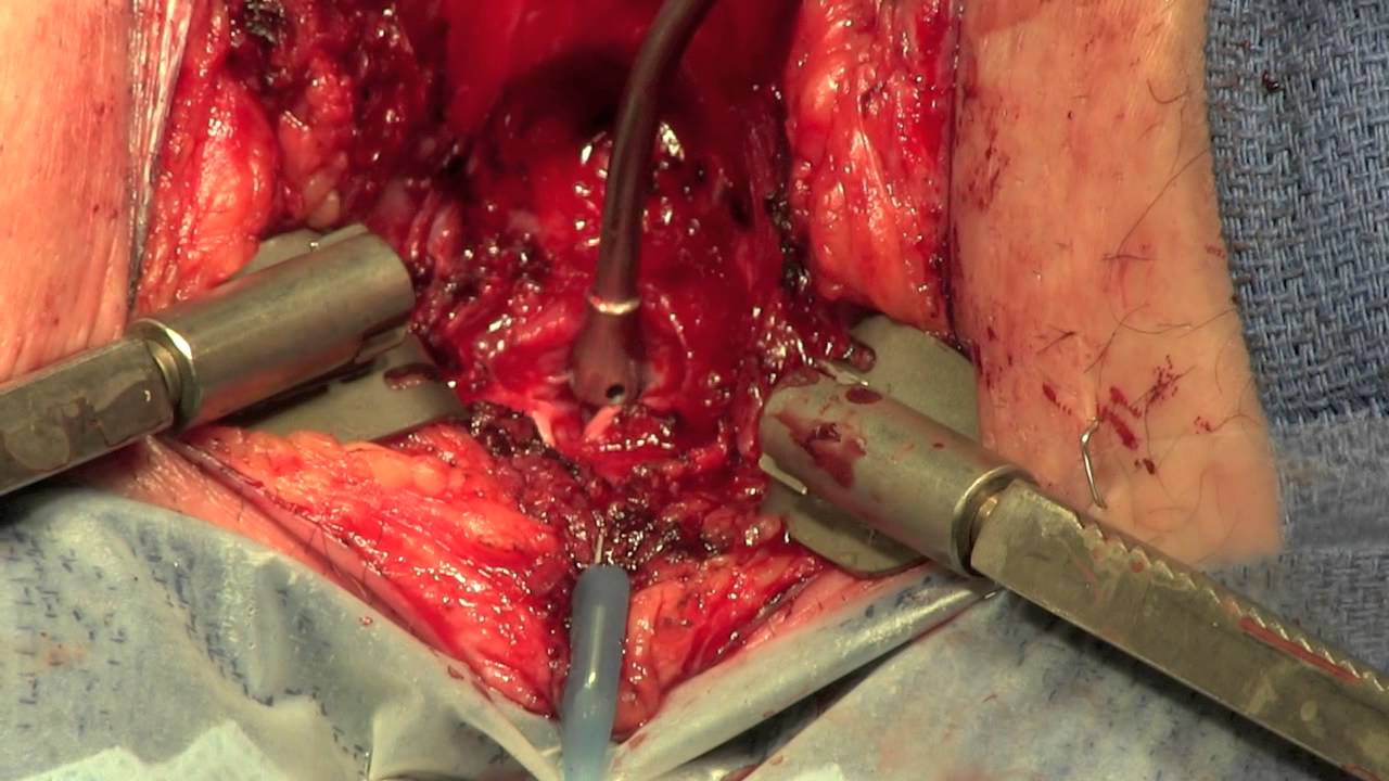 Posterior Urethroplasty for Pelvic Fracture Urethral Injury - YouTube