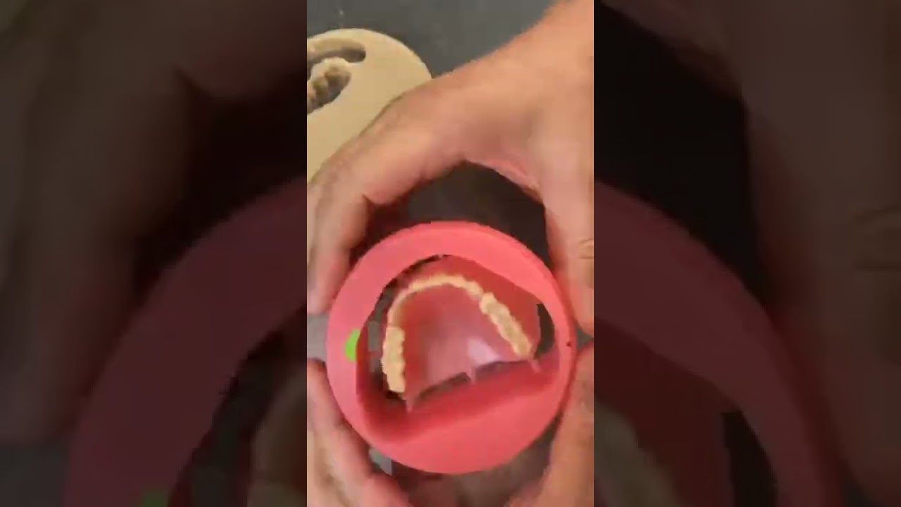 CAD/CAM removable partial denture - YouTube