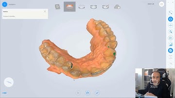 1- LIVE dental training intraoral shining3d scanner + exocad integration