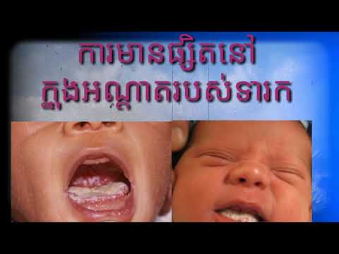 មូលហេតុធ្វើអោយមានផ្សិតអណ្តាតចំពោះទារកដែលកំពុងបៅដោះម្តាយ