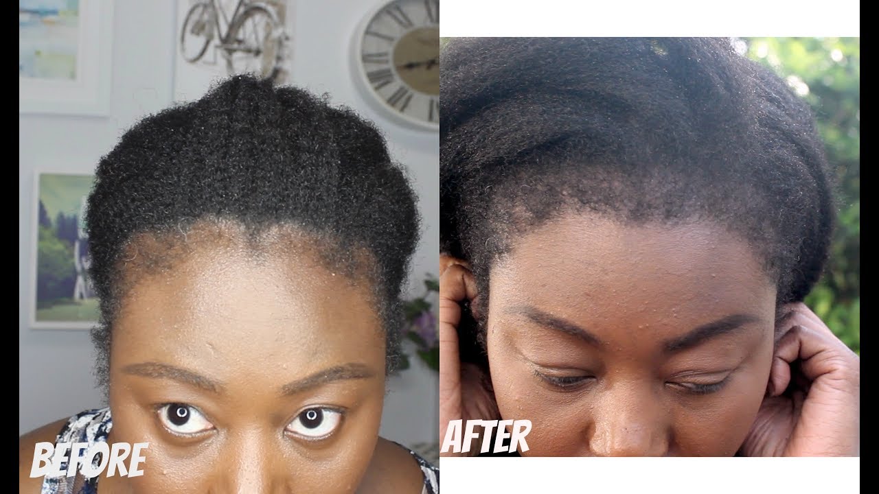 6 Months Post Hair Transplant Update Youtube