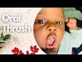 WHITE COAT ON NEWBORN TONGUE (2021) | FIRST TIME PARENTS MUST KNOW THIS!