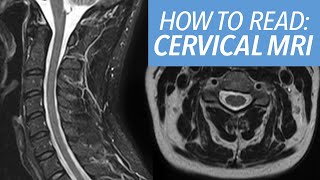 How to Read an MRI of the Cervical Spine: Beginner