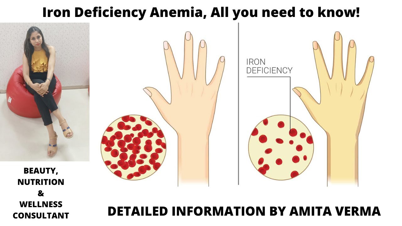 anemia pica symptoms anemia pica symptoms