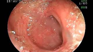 31122018 EMR for Sigmoid Sesil Lesion