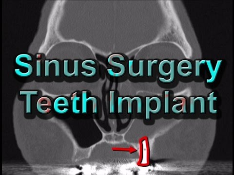 How is Functional Endoscopic Sinus Surgery Perfome...