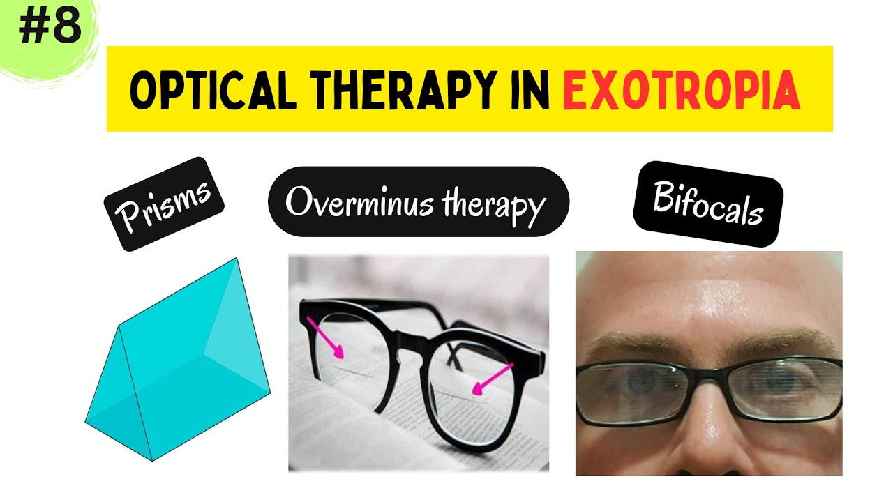 optical-therapy-in-exotropia-prisms-overminus-therapy-and-tinted