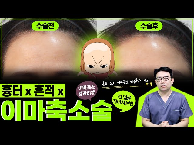 [이마축소술] 흉터를 최소화 시키면서 할 수 있는 이마축소술 수술 전후 비교 | 우리뷰티TV