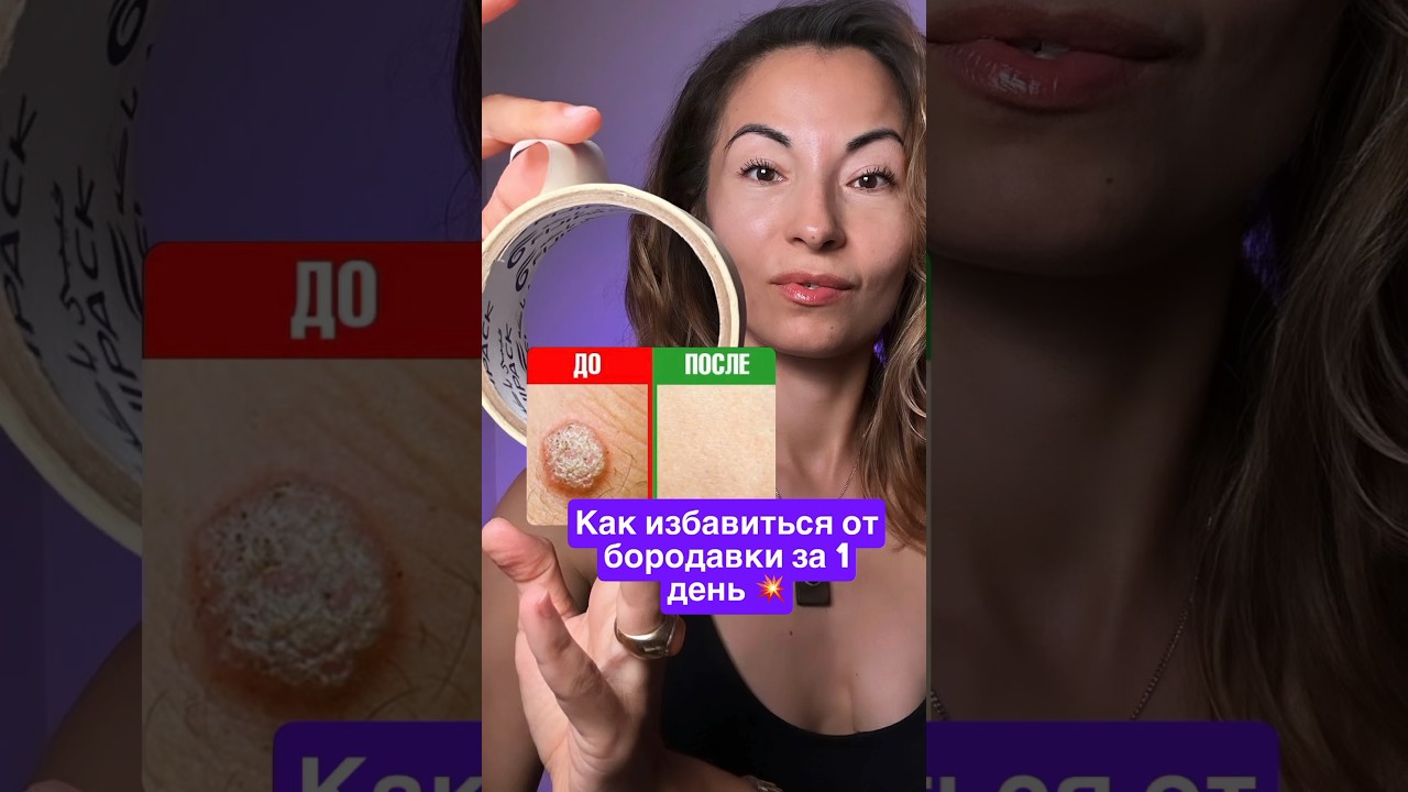 Как избавиться от бородавки за 1 день 💥