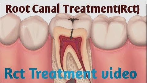 Root Canal Treatment Step by Step | Full Dental Procedure #dentist #teeth #rootcanaltreatment #005