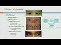 Oculomotor Systems and Strabismus and Amblyopia Programs With Dr. Houmam Araj (Audio Description)