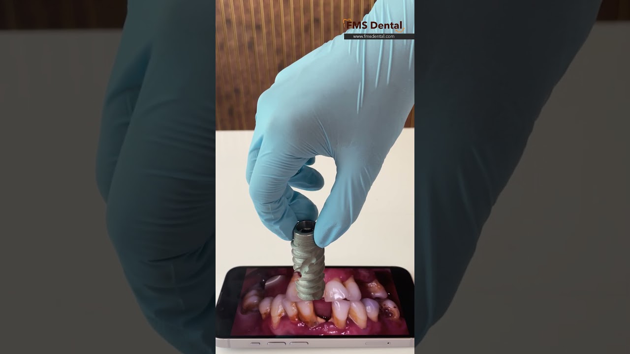 Experience precision and excellence in Dental Implants at FMS Dental | Expert Dental Implant Surgeon