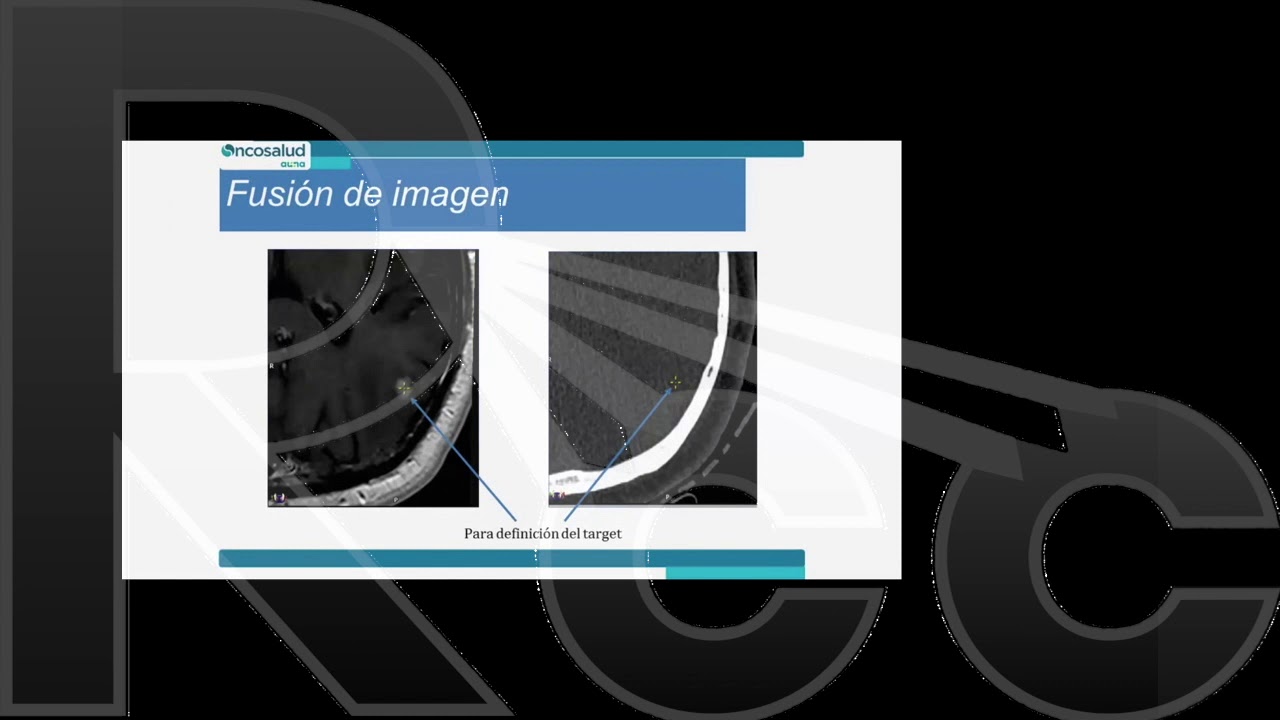RCC SBRT/SRS 2.0 Session 6: Cases of SRS | AUNA Clinic