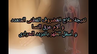 دكتور فادى مرقص - حالة تحكى كيف تم علاجها من ألم الغضروف و عرق النسا بالساقيين بالتردد الحرارى