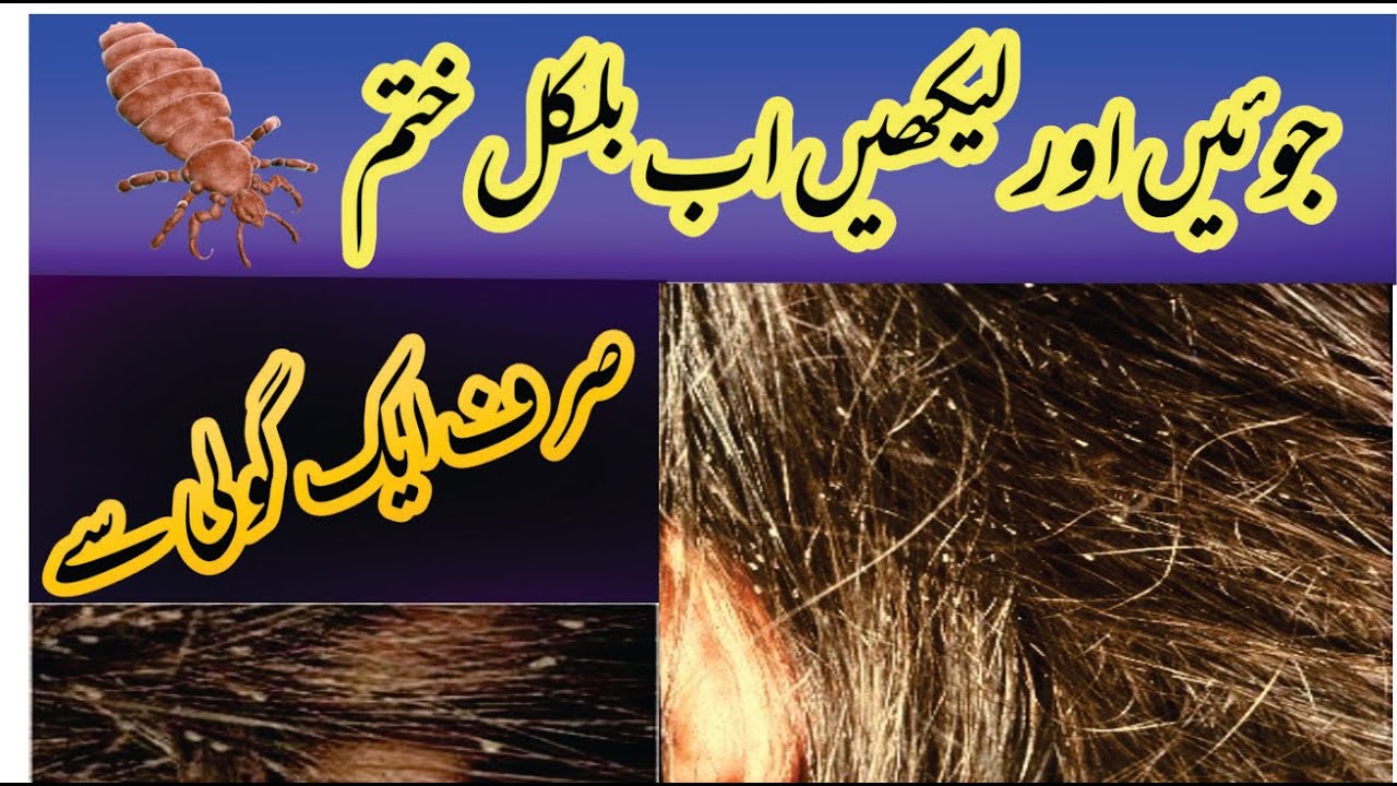 How To Get Rid Of Lice Just Remove With 1Tablet Urdu Hindi 