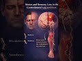 Stroke Localization Hack: ACA vs. MCA
