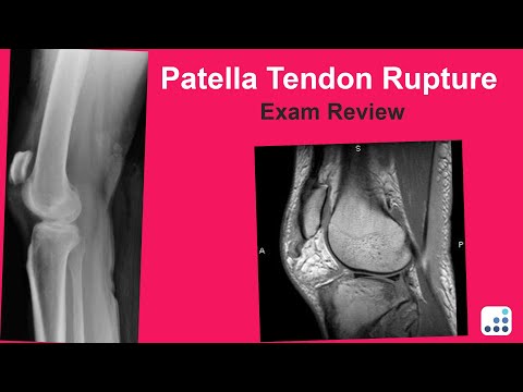 Patella Tendon Rupture Exam Review - C. Lowry Barnes, MD