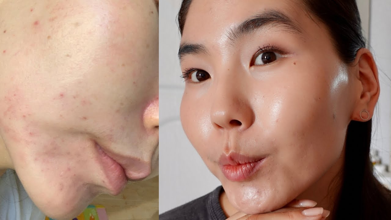 “SKIN BARRIER” буюу “АРЬСНЫ ХОРИГ”-ийн тухай. Хэрхэн төлжүүлэх, нөхөн сэргээх вэ? 🧏🏻‍♀️