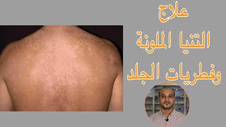 علاج حالات التنيا الملونة وفطريات الجلد