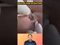 Dilated Pore of Winer… SO SATISFYING 🤯 #shorts