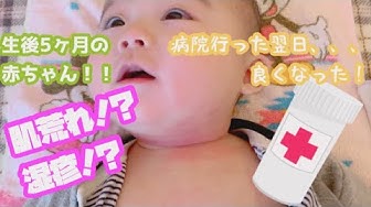 乳児湿疹 Youtube