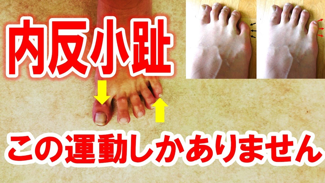 内反小趾の原因と自分でできるセルフケア