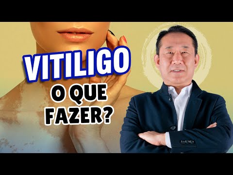 VITILIGO COMO TRATAR | Peter Liu